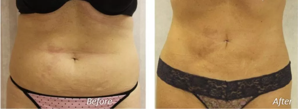 Before after picture of tummy work done by richmond plastic surgeons