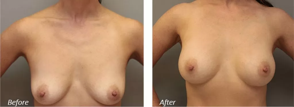 before after work of breast augmentation done by richmond plastic surgeons