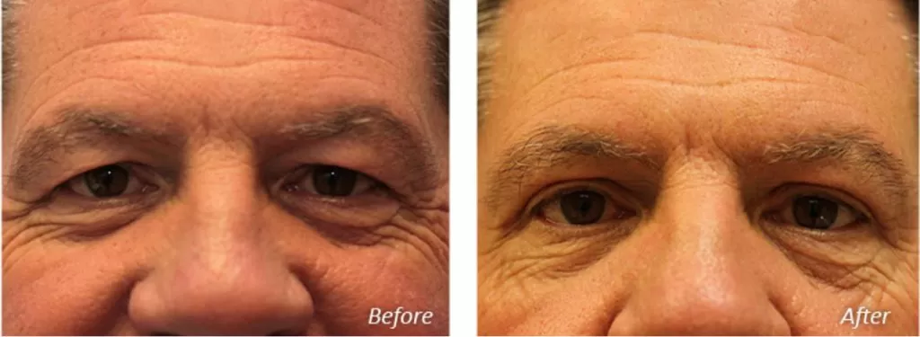 before after picture of facial surgery done by richmond plastic surgeons