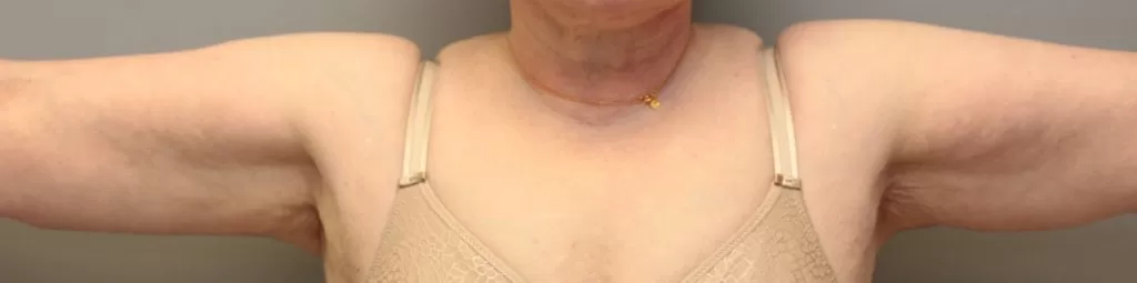 after image of brachioplasty in richmond
