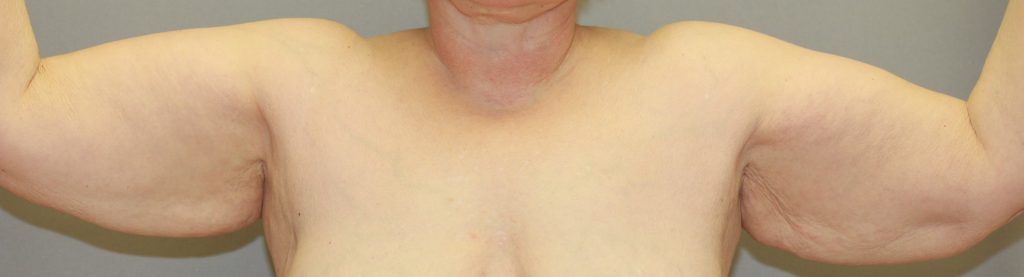 before image of Brachioplasty