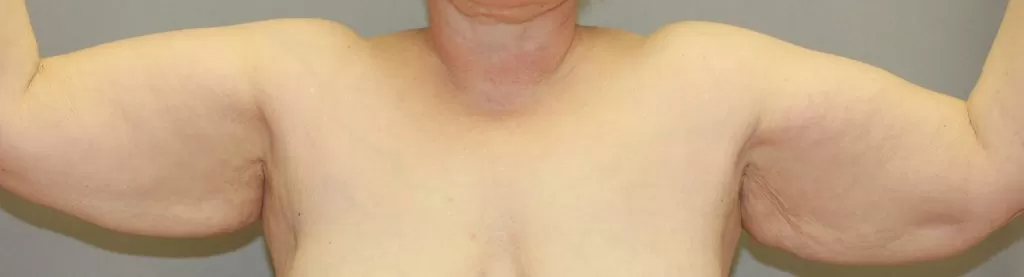 before image of brachioplasty in richmond