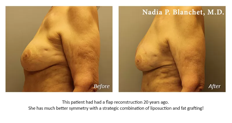 breast liposuction Before-After