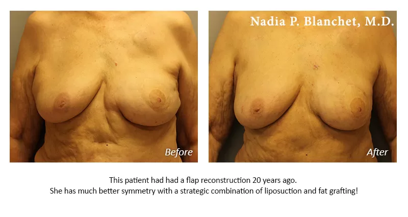 breast liposuction Before-After