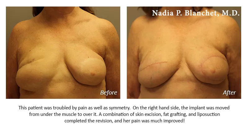 breast revision Before-After