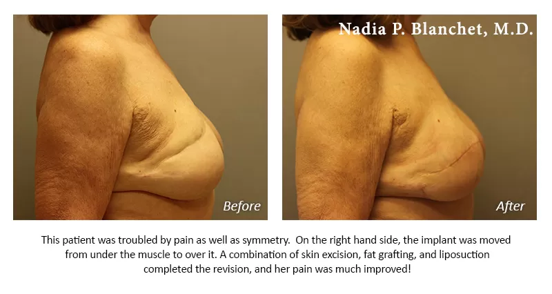 breast revision Before-After