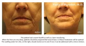 facelift laser resurfacing Before-After