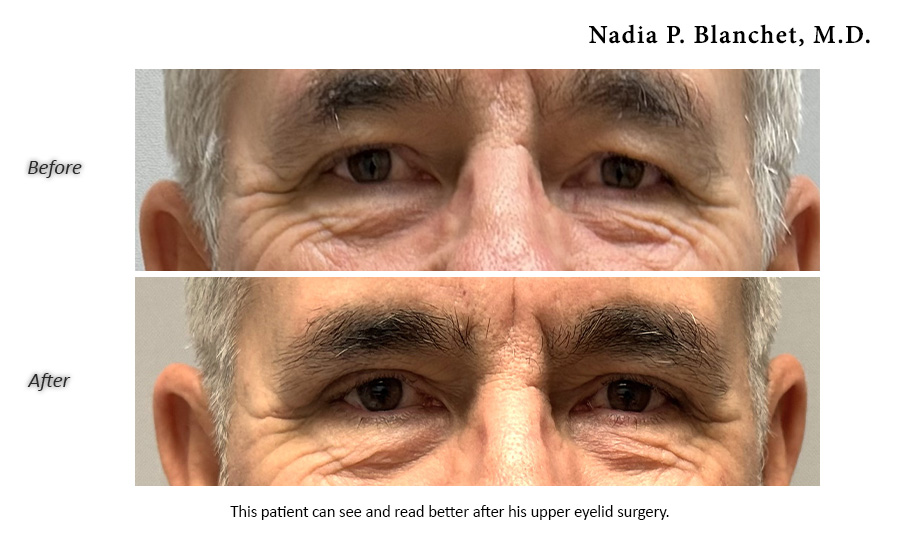 blepharoplasty patient before and after