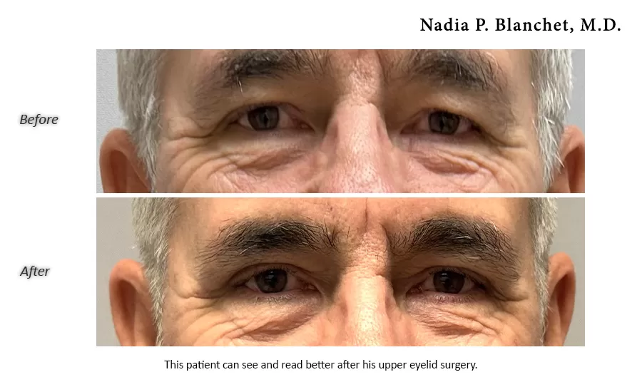 blepharoplasty patient before and after