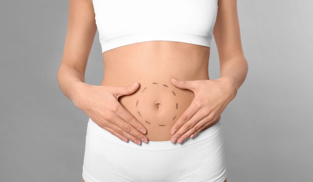woman with markings for tummy tuck in richmond va