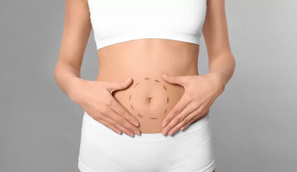 woman with markings for tummy tuck in richmond va