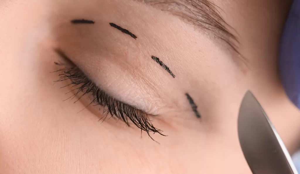 woman receiving blepharoplasty in forest hills