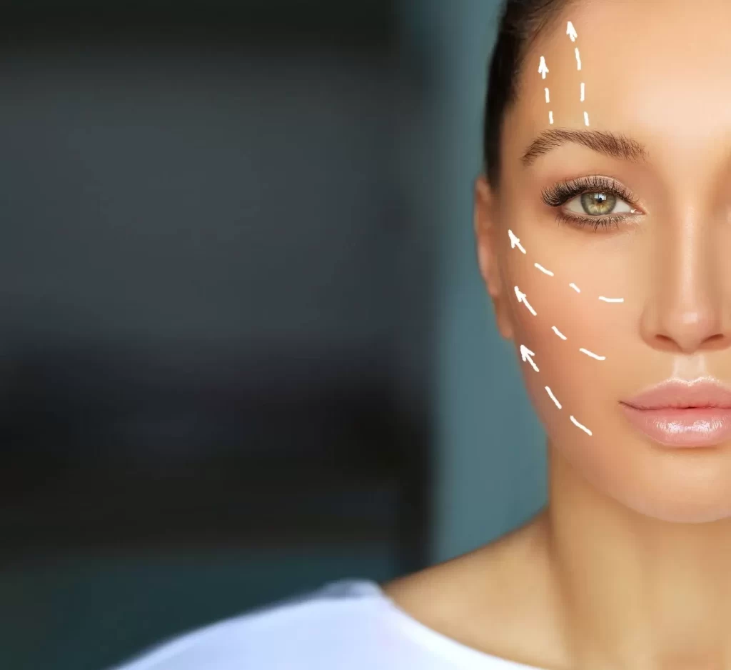 woman with Lateral Facelift arrows on her face