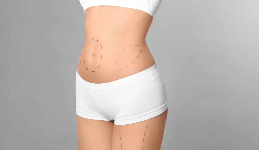 liposuction in Richmond